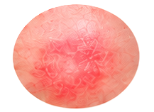 Eczema Treatment
