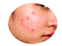 Acne Treatment
